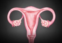 Mujeres con síndrome de ovario poliquístico son propensas a presentar depresión y ansiedad